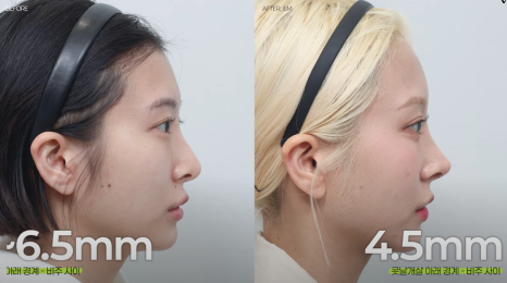 코재수술 원인, 과연 코끝처짐만이 문제일까? 가장 이상적인 라인 알려드립니다 관련 이미지 26