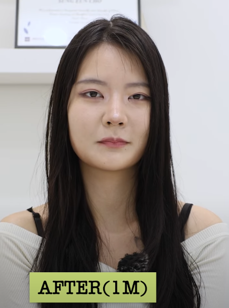 바바성형외과 복코&middot;매부리코&middot;휜코 동시 교정! 직반라인 코성형 리얼 후기 관련 이미지 2