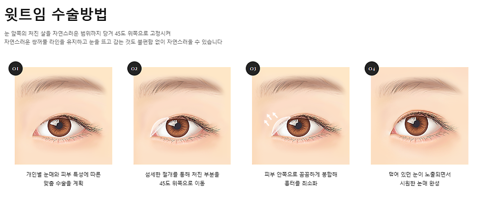 트임이 필요한 눈매와 트임 수술법 관련 이미지 5