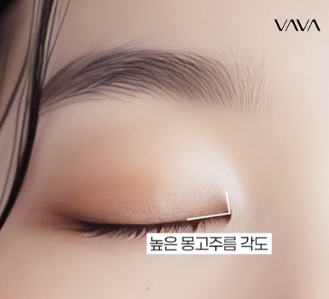 자연유착 VS 절개  어떤 기준으로 선택해야 할까? 관련 이미지 14