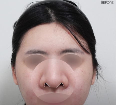 예쁜 코의 공통점은? 성형외과 원장이 알려주는 코 성형 성공하는 방법(리얼 후기 케이스) 관련 이미지 23