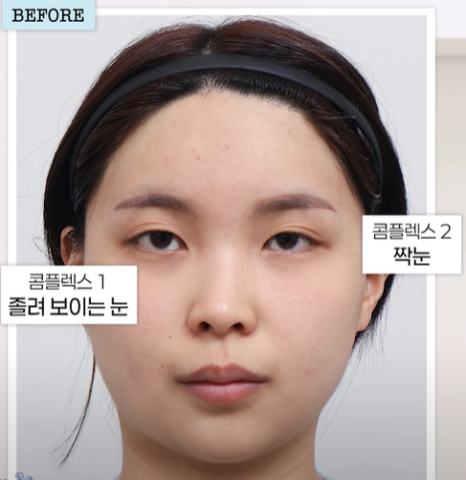 쌍수 재수술 성공기 ｜ 졸려보이는 눈 세미아웃으로 예뻐진 리얼 Before & After 관련 이미지 2