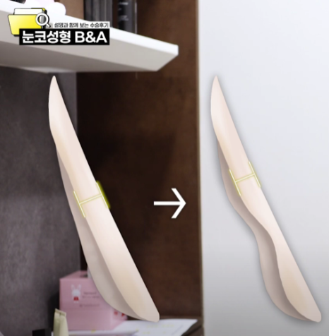 복코 매부리코 긴코 교정 ㅣ 코성형 전후 케이스 (NJZ민지 코) 관련 이미지 17