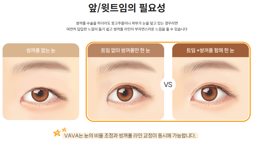 또렷하면서도 자연스러운 눈매를 완성하는 기준, 쌍꺼풀 수술의 방향성 관련 이미지 4