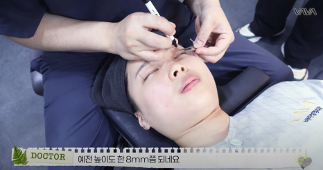 쌍수 재수술 성공기 ｜ 졸려보이는 눈 세미아웃으로 예뻐진 리얼 Before & After 관련 이미지 5