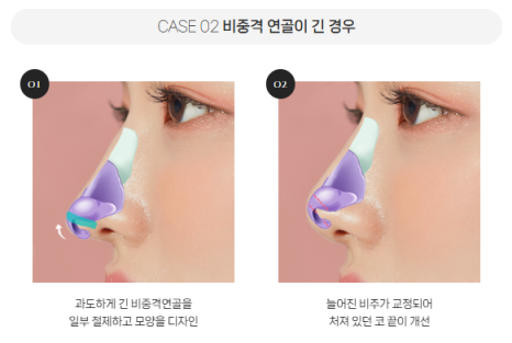 복코, 매부리코, 낮은코 | 바바성형외과 유형별 코성형, 내 코에 맞는 방향 찾기 관련 이미지 14