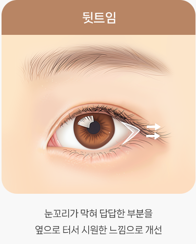 트임이 필요한 눈매와 트임 수술법 관련 이미지 6