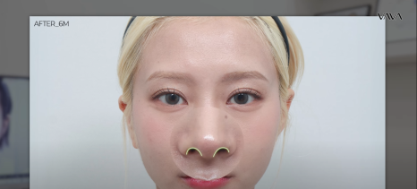 코재수술 원인, 과연 코끝처짐만이 문제일까? 가장 이상적인 라인 알려드립니다 관련 이미지 19