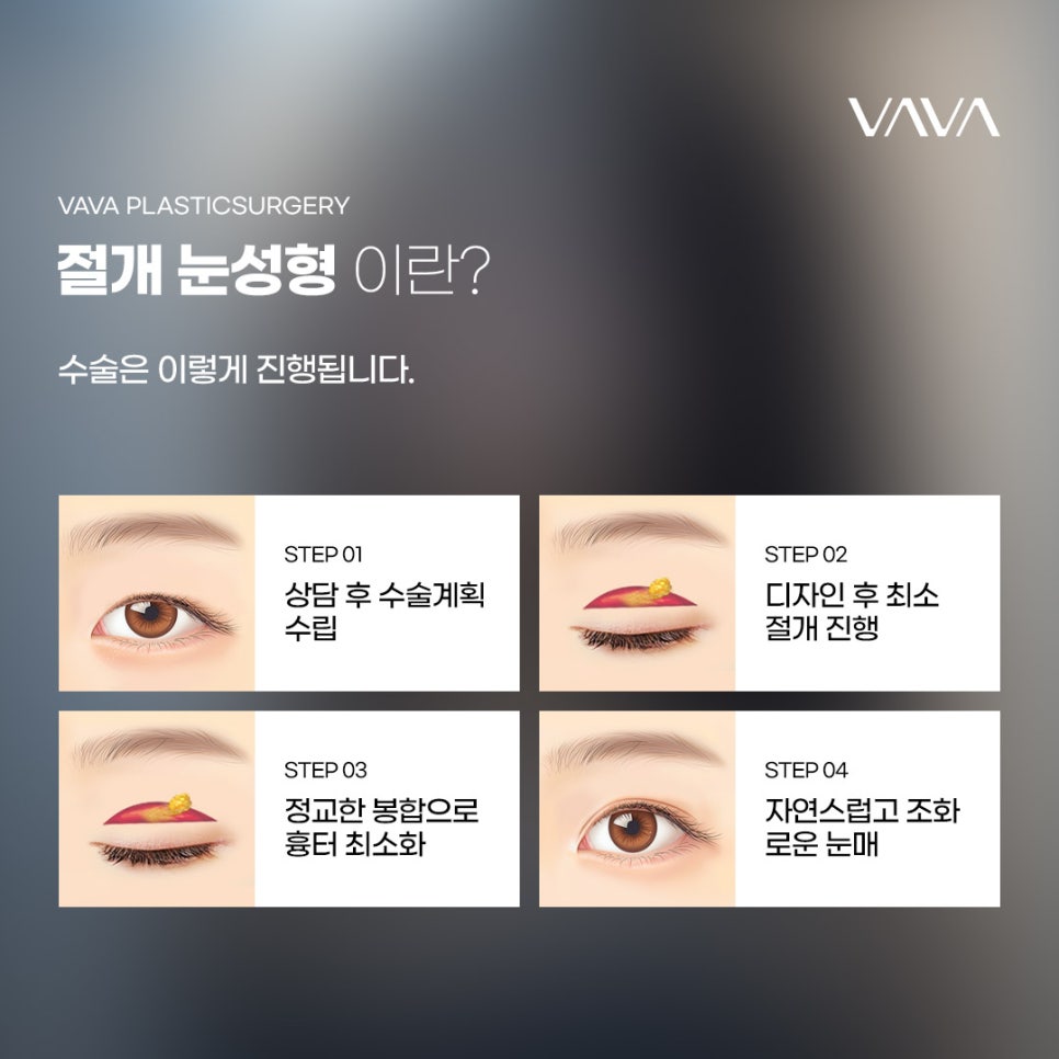 절개 눈성형 방법과 절개가 필요한 눈 유형 관련 이미지 2