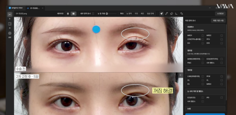 쌍수 후 생겨버린 짝눈 교정 눈의 균형을 맞추는 섬세한 방식 관련 이미지 16