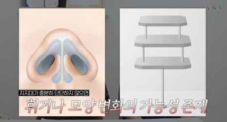 첫 코 성형, 언제&middot;어떻게 해야 할지 기준 정리해드립니다 관련 이미지 20