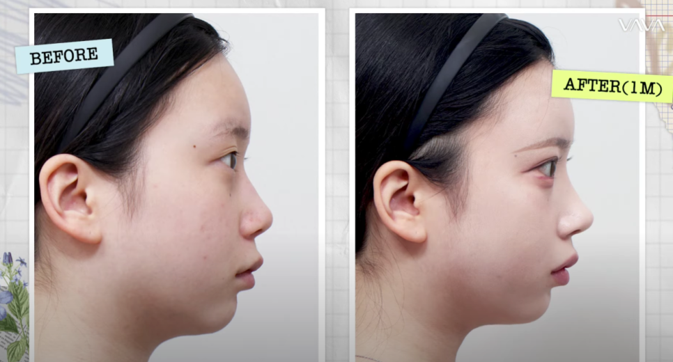 바바성형외과 눈&middot;코 성형 한 달 차 리얼 케이스 (윈터, 카리나 코) 관련 이미지 16