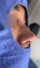 복코 수술전후 개선 된 인상 관련 이미지 10