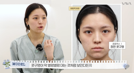 보형물 없이 선명하게｜바바성형외과 무보형물 매부리코 교정 리얼 후기 관련 이미지 3