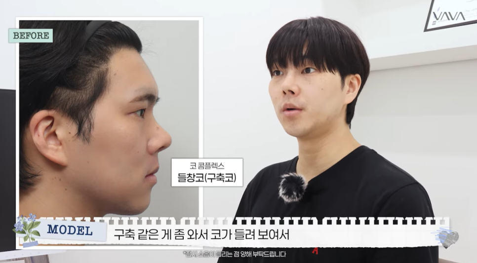 눈&middot;구축코 재수술 후기｜남자 눈코 재수술, 압구정 바바에서 달라진 이유 관련 이미지 9