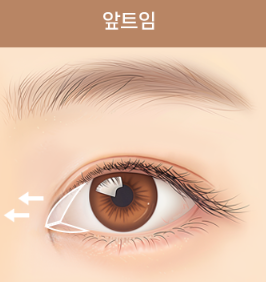 쌍꺼풀 수술만으로 충분할까? 눈 트임이 필요한 경우 관련 이미지 3