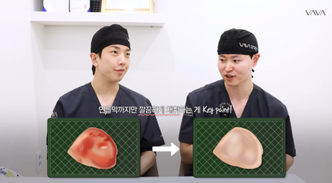 코성형 재료 총정리｜실리콘 부작용&middot;자가늑연골 와핑&middot;귀연골 흡수까지 (콧대 코끝 비교) 관련 이미지 17
