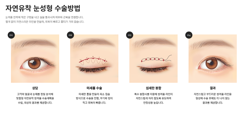 여름철 휴가 전 쌍꺼풀 수술 붓기 관리와 회복 TIP 관련 이미지 3