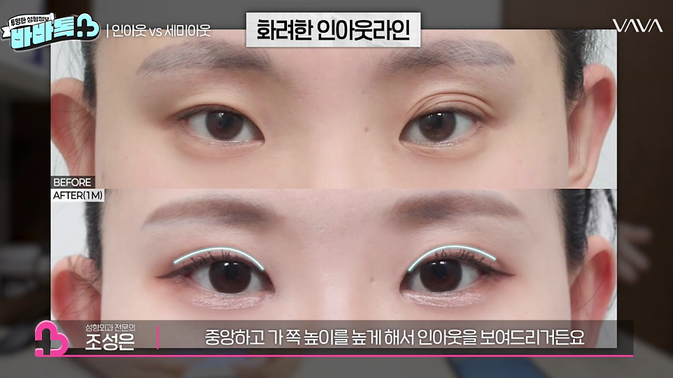 세미아웃라인 인아웃라인 쌍꺼풀 잘 받는 타입 (몽고주름) 관련 이미지 15
