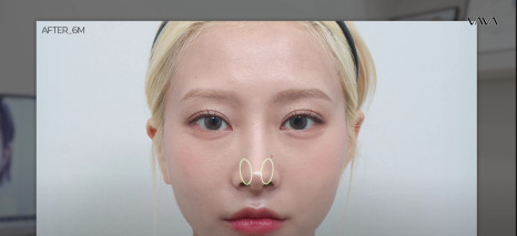 코재수술 원인, 과연 코끝처짐만이 문제일까? 가장 이상적인 라인 알려드립니다 관련 이미지 18