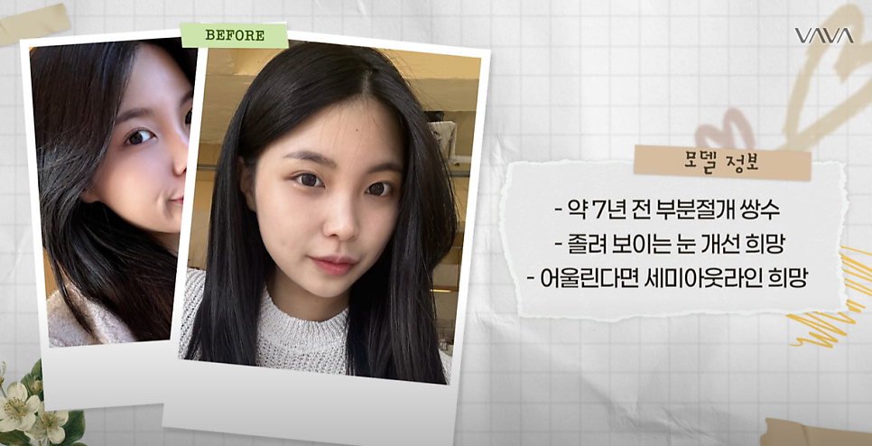 쌍수 재수술 성공기 ｜ 졸려보이는 눈 세미아웃으로 예뻐진 리얼 Before & After 관련 이미지 3