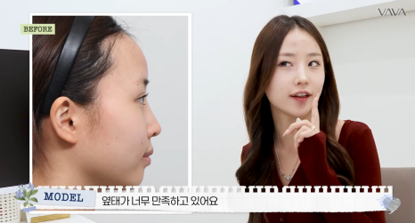 코재수술로 인상까지 달라질 수 있을까?｜바바성형외과 직반라인 코재수술 후기 관련 이미지 23