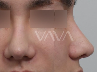 복코 수술전후 개선 된 인상 관련 이미지 8