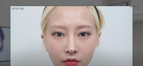 코재수술 원인, 과연 코끝처짐만이 문제일까? 가장 이상적인 라인 알려드립니다 관련 이미지 17