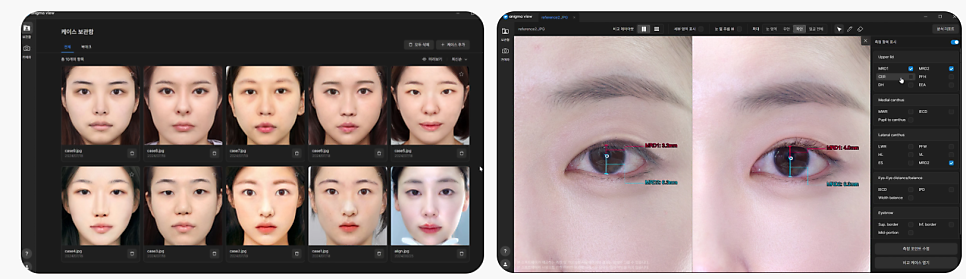 세미아웃라인 쌍수 장원영 쌍꺼풀 분석해 보기 관련 이미지 8