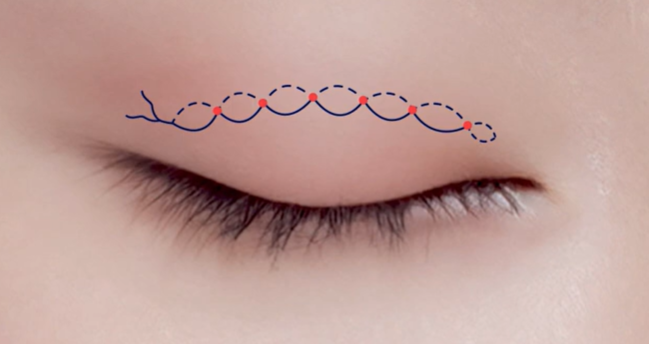 자연유착 vs 매몰 쌍꺼풀, 같은 비절개인데 왜 다를까요? 관련 이미지 4