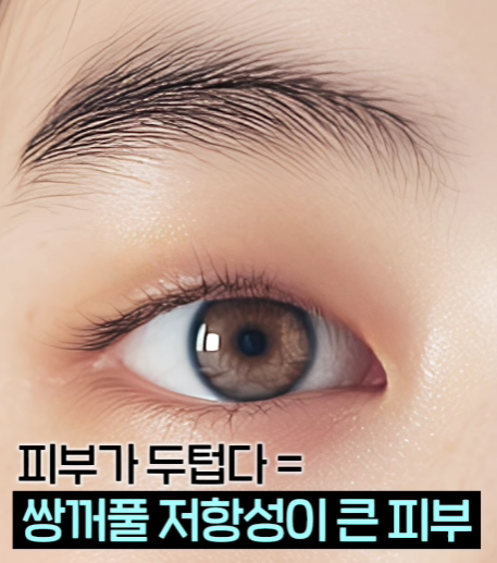 졸려 보이는 눈 안검하수 절개 쌍수 전후 차이 관련 이미지 6