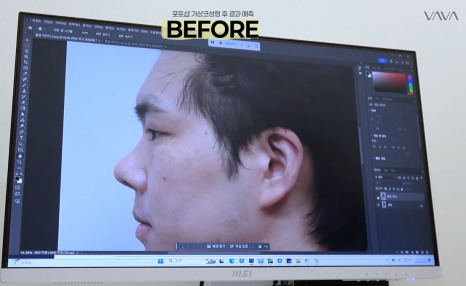 눈&middot;구축코 재수술 후기｜남자 눈코 재수술, 압구정 바바에서 달라진 이유 관련 이미지 10