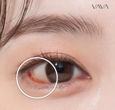 뒤밑트임 수술, 잘 되는 눈 따로 있습니다｜추천 대상&middot;부작용&middot;재유착 정리 관련 이미지 23