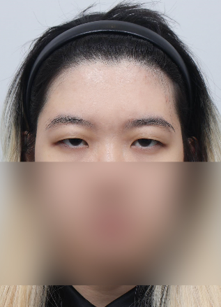 졸려 보이는 눈 안검하수 절개 쌍수 전후 차이 관련 이미지 4