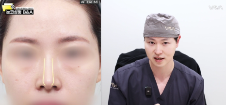 복코 매부리코 긴코 교정 ㅣ 코성형 전후 케이스 (NJZ민지 코) 관련 이미지 13