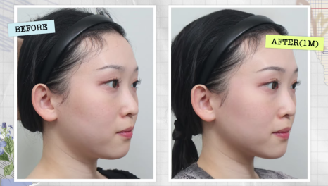 울쎄라 효과 언제부터? 윤곽까지 바뀌는 리프팅, 압구정 바바성형외과(리얼후기) 관련 이미지 3