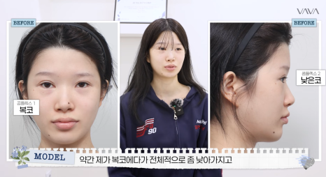 압구정 바바성형외과 자가늑 코성형 후기｜복코&middot;매부리코 교정 한달차 변화 관련 이미지 3