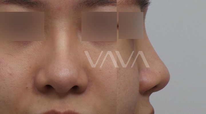 첫 재수술 실패로 잃어버린 코 라인 되찾기 관련 이미지 6