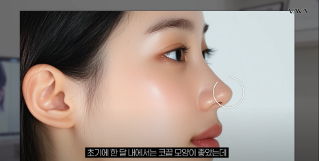 요즘 코성형 트렌드 & 코끝 재수술 알아보기 관련 이미지 6