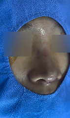 복코 수술전후 개선 된 인상 관련 이미지 3