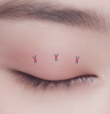 나에게 맞는 쌍꺼풀 수술법 총정리 : 절개, 부분절개, 매몰법까지 관련 이미지 6