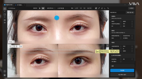 쌍수 후 생겨버린 짝눈 교정 눈의 균형을 맞추는 섬세한 방식 관련 이미지 15