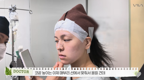 보형물 없이 선명하게｜바바성형외과 무보형물 매부리코 교정 리얼 후기 관련 이미지 7