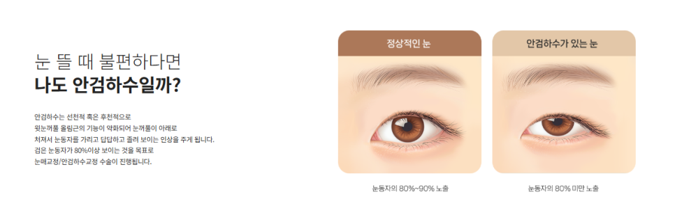 압구정 눈성형, 자연스럽게 달라지는 첫인상 관련 이미지 8