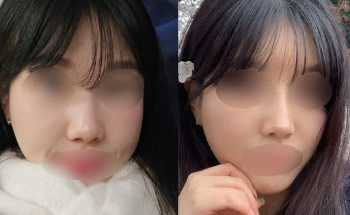 2025년 코성형 트렌드: 자연스러움이 대세 관련 이미지 5