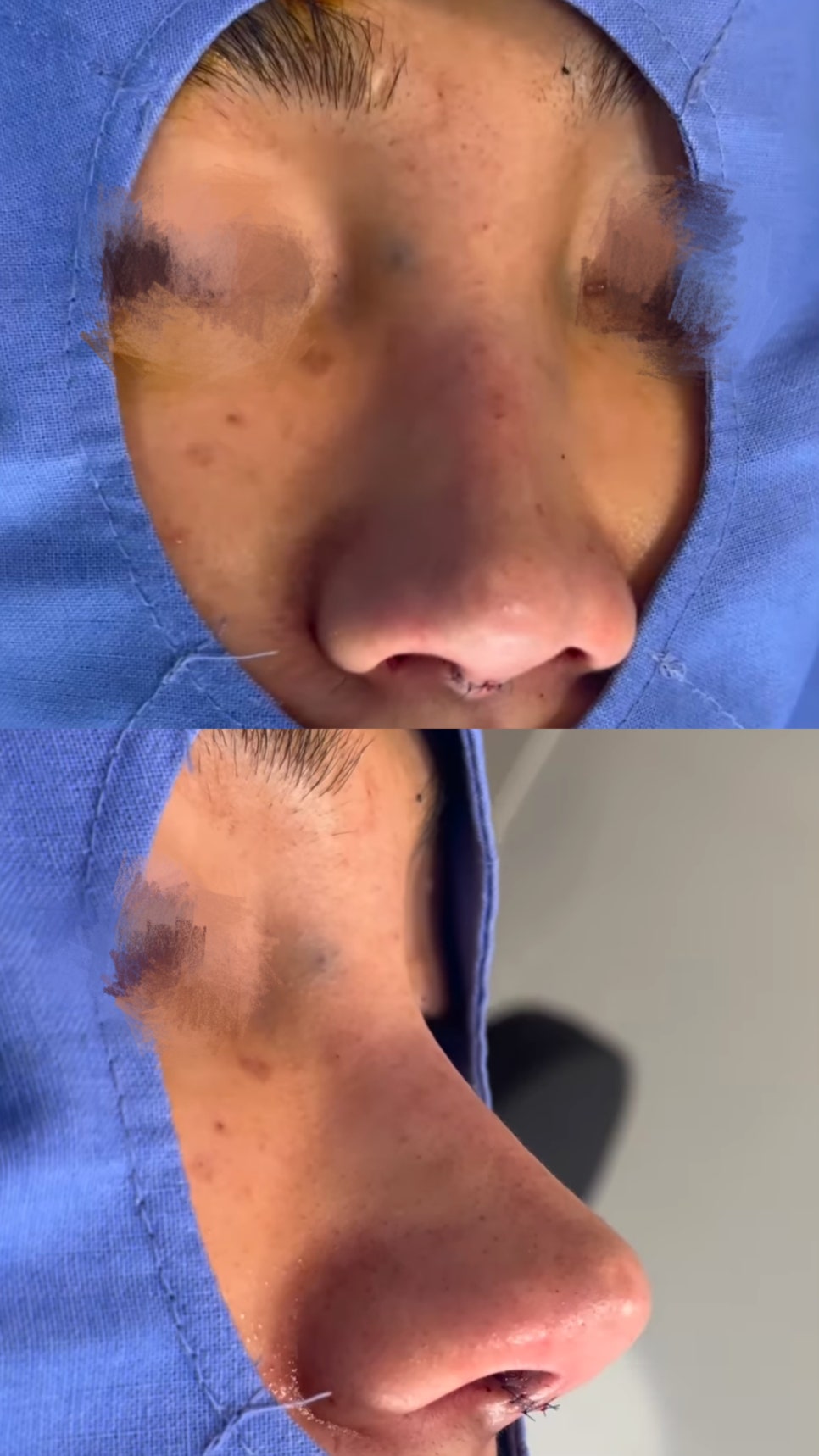 첫 재수술 실패로 잃어버린 코 라인 되찾기 관련 이미지 5
