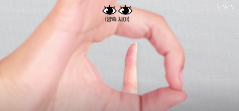 쌍수 후 생겨버린 짝눈 교정 눈의 균형을 맞추는 섬세한 방식 관련 이미지 24