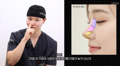 코성형 재료 총정리｜실리콘 부작용&middot;자가늑연골 와핑&middot;귀연골 흡수까지 (콧대 코끝 비교) 관련 이미지 8
