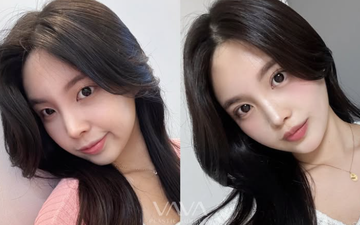 쌍꺼풀 수술만으로 충분할까? 눈 트임이 필요한 경우 관련 이미지 7