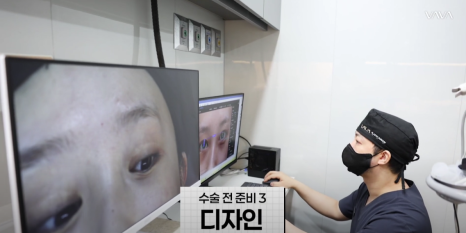 바바성형외과 절개 쌍수 절개 눈매교정 쌍꺼풀  재수술  사례 관련 이미지 14